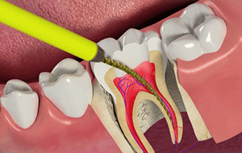 sensivity tooth